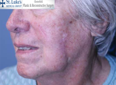 Skin Cancer and Mohs Reconstruction Results Chesterfield, MO