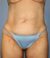 Tummy Tuck