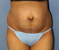 Tummy Tuck