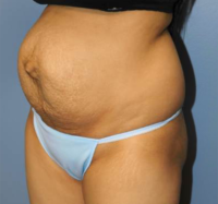 Tummy Tuck