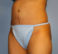 Tummy Tuck