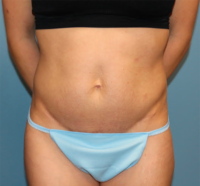 Tummy Tuck