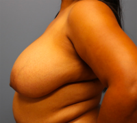 Breast Reduction