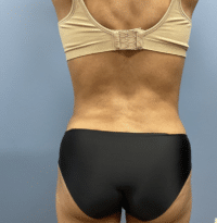 Tummy Tuck