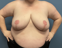 Breast Reduction