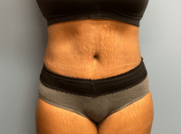 Tummy Tuck