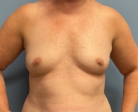 Breast Augmentation