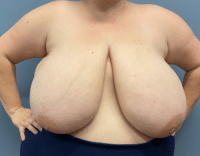 Breast Reduction