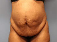 Tummy Tuck