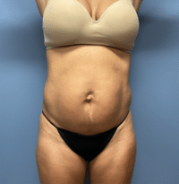 Tummy Tuck