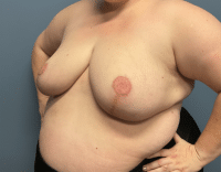 Breast Reduction