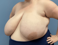 Breast Reduction