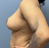 Breast Reduction