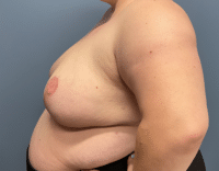 Breast Reduction