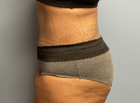 Tummy Tuck