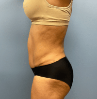 Tummy Tuck