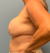 Breast Implant Removal