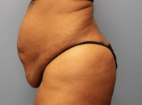 Tummy Tuck