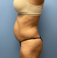 Tummy Tuck