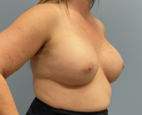 Breast Augmentation