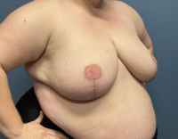 Breast Reduction