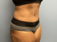 Tummy Tuck