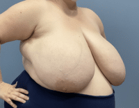 Breast Reduction