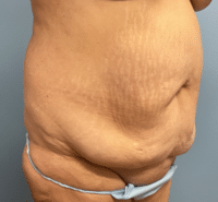 Tummy Tuck