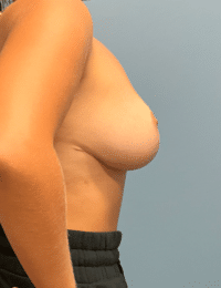 Breast Reduction