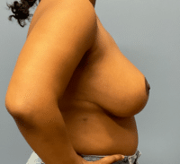 Breast Reduction