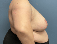 Breast Reduction