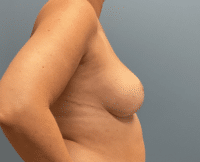 Breast Reduction