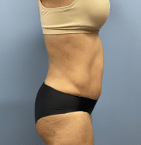 Tummy Tuck