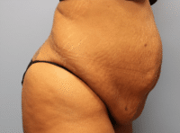 Tummy Tuck